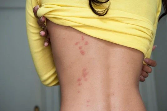 enfermades chinches