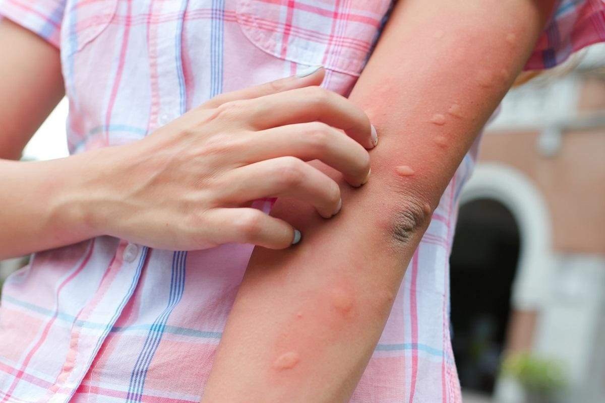 picaduras mosquito tigre